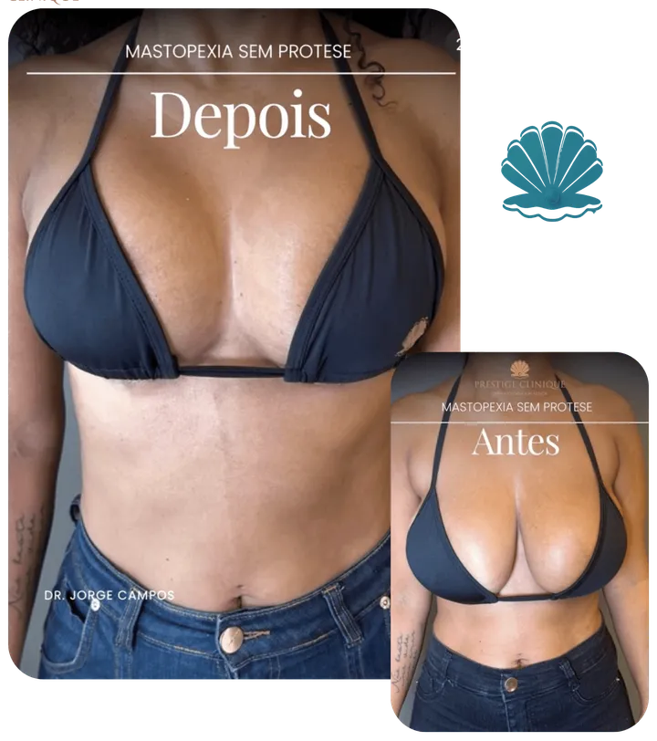 Resultado antes e depois
